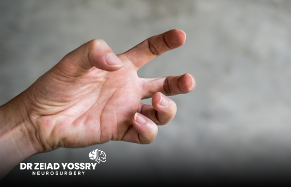 The-Latest-Treatment-for-Dystonia