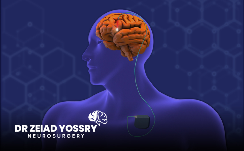 Deep-Brain-Stimulation-for-Movement-Disorders