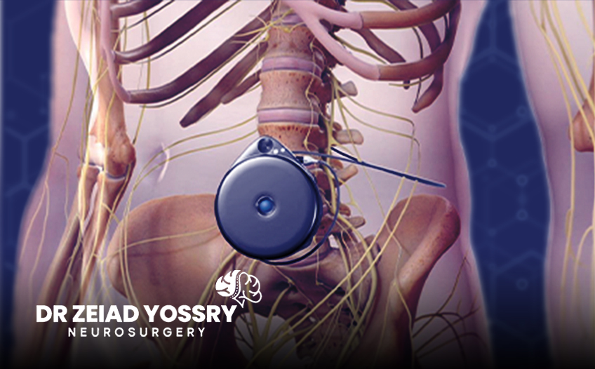 Managing-Spasticity-with-Intrathecal-Baclofen-Pump