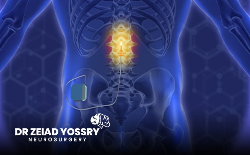 Spinal-Cord-Stimulation-for-Chronic-Pain