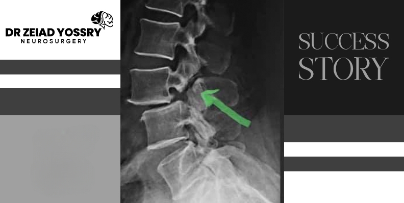 Overcoming-a-Herniated-Disc-and-Lumbar-Vertebra-Fracture