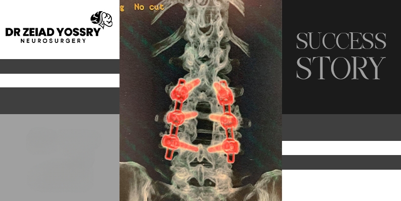 Recovery -of-a-Woman-from-a-Lumbar-Vertebra-Fracture