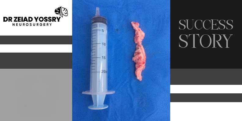 Rescuing-from-a-Ruptured-Lumbar-Disc-After-Complete-Foot-Drop