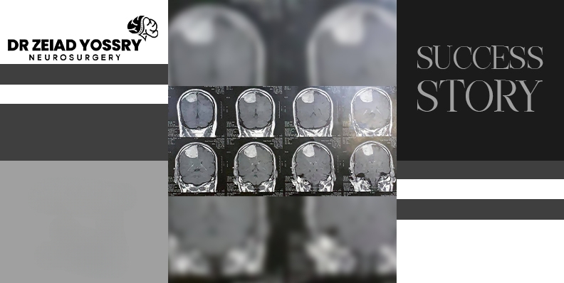 Successful-Complete-Brain-Tumor-Removal-Surgery