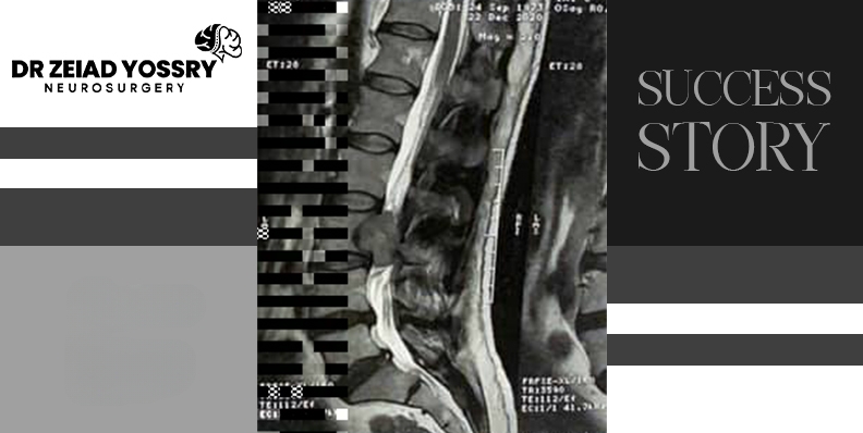 Successful-Removal-of-a-Large-Spinal-Cord-Tumor