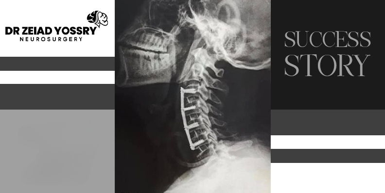 Successful-Surgical-Treatment-for-Multiple-Cervical-Disc-Herniations