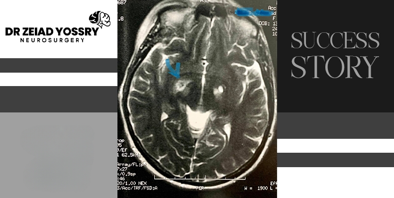 Tremor-Relief-for-a-Parkinson-Patient-After-Basal-Ganglia-Ablation-Surgery